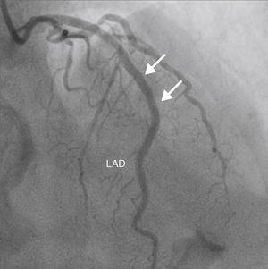Coronary angiogram after stent graft implantation showing sealing of the LAD rupture area and loss of the second diagonal branch (arrows). LAD: left anterior descending artery.