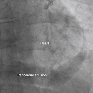 Final fluoroscopic image showing circumferential pericardial effusion.