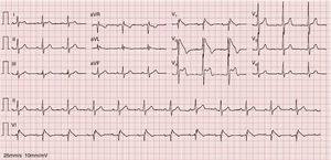 Electrocardiogram at peak of fever showing right bundle branch block and ST-segment elevation, downsloping in V1–V2 and horizontal in V3, with T-wave inversion.