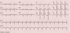 Electrocardiogram after resolution of infection showing type 3 Brugada pattern.