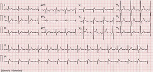Electrocardiogram with leads V1 and V2 in the third intercostal space revealing a type 1 Brugada pattern.