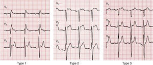 Types 1, 2 and 3 Brugada electrocardiographic patterns.