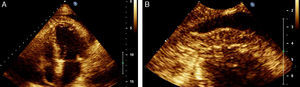 (A) Transthoracic echocardiogram, apical 4-chamber view; (B) detail of the previous image at the level of the left ventricular apex.