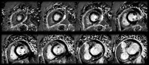 Cardiovascular magnetic resonance imaging of late enhancement (phase-sensitive inversion recovery), short-axis view.