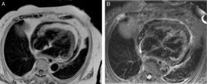 (A) Cardiovascular magnetic resonance imaging, T2 turbo spin echo, transverse (axial) plane; (B) same projection with fat saturation (T2 – short TI inversion recovery).