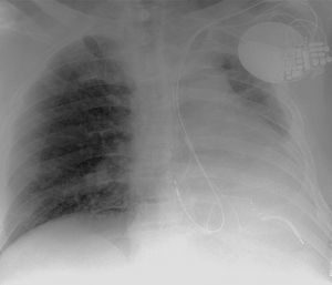 Chest X-ray immediately after implantation of a cardiac resynchronization therapy defibrillator through a persistent left superior vena cava.