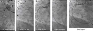 Angiographic images of an 83-year-old woman who underwent coronary artery bypass grafting in 1994, with Canadian Cardiac Society class III angina. A critical mid right coronary artery lesion was the culprit lesion. Radial access and a 6F Amplatzer AR1 guide were used. (A) A Terumo Runthrough floppy wire easily crossed the lesion, but a 2.0 mm×15 mm compliant Mini Trek balloon (Abbott) could not; (B) wires exchanged through the microcatheter and rotational atherectomy with 1.25 mm burr performed; (C) post-rotational atherectomy image; (D) further dilatation with a 2.5 mm×20 mm balloon followed by prolonged inflation of a 2.5 mm×20 mm drug-eluting SeQuent Please balloon (B. Braun); (E) final result.