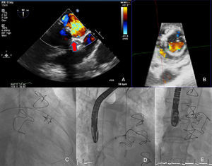 Transesophageal echocardiography showing severe anterolateral paraprosthetic regurgitation (A and B). During percutaneous closure two sheaths were advanced across the mitral leak and an Amplatzer Vascular Plug III (C and D) and an Amplatzer Duct Occluder (E) were deployed.