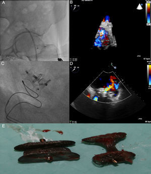 Fluoroscopy showing embolization of the Amplatzer Duct Occluder to the left femoral artery (A). Transesophageal echocardiography (TEE) revealed severe paraprosthetic regurgitation (B). An Amplatzer Muscular VSD Occluder was implanted near to the previous device (C). Three months later, TEE showed moderate paraprosthetic regurgitation (D). The devices were surgically removed (E).