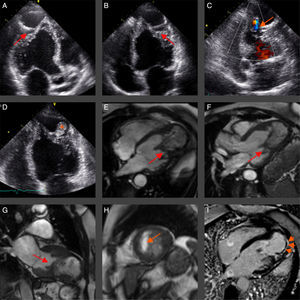 Echocardiographic and cardiac magnetic resonance images of a case of hypertrophic cardiomyopathy with ‘burned out’ apex complicated by an apical thrombus.