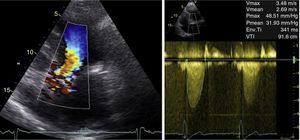 Transthoracic echocardiography: (left) color Doppler showing turbulent flow beginning in the left ventricular outflow tract; (right) continuous-wave Doppler showing rounded waveform with mid-systolic peak (bell-shaped) and peak and mean left ventricular/aortic gradient of 49 mmHg and 32 mmHg, respectively.