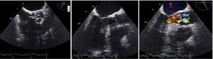Transesophageal echocardiography: (left) malformed aortic valve with area calculated by planimetry of 0.6 cm2; (center) left ventricular outflow tract without visible obstruction; (right) color Doppler differentiating laminar flow in the left ventricular outflow tract and turbulent flow through the aortic valve, confirming obstruction at the level of the valve.