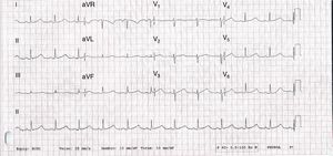 12-lead electrocardiogram showing sinus rhythm and significant QTc prolongation (565 ms).