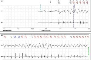 Intracardiac electrogram from implantable cardioverter-defibrillator showing polymorphic ventricular tachycardia detected by remote monitoring.