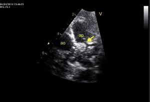 Transthoracic echocardiogram in parasternal short-axis view, showing an anomalous left coronary artery (arrow) from the pulmonary artery. ao: aorta; ap: pulmonary artery.