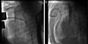 Angiographic images: (a) stent positioning in the ductus arteriosus; (b) fully expanded stent.
