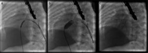 Angiographic images: (a) stent positioning at the level of the interatrial septum; (b) stent expansion; (c) fully expanded stent.