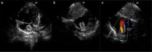 Transthoracic echocardiography of a patient with hypoplastic left heart syndrome after stent implantation into the interatrial septum. (a and b) Two-dimensional image; (c) color Doppler imaging of the flow through the implanted stent.