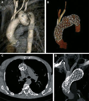 Pre-procedure computed tomography angiography (CTA) showing a large aneurysm in the distal aortic arch involving the origin of the left subclavian artery (A). Follow-up CTA at one month revealed no endoleak and patency of the innominate and LCCA stent grafts (B, C, D).