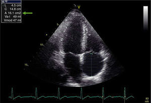 Measurement of right atrial area using the planimetry method from apical 4-chamber view. The green arrow shows this patient's right atrial area.