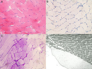 Neuropathology of the muscle biopsy. H&E staining (A) shows discrete fiber size variation, fiber splitting and internalized nuclei; Oil-red-O staining (B) shows increased lipid accumulation; PAS-staining (C) shows storage of excess glycogen; Excess glycogen deposits are also detectable at an ultrastructural level within and between the fibers (A-C) ×20 magnification (D) × 3000 magnification.