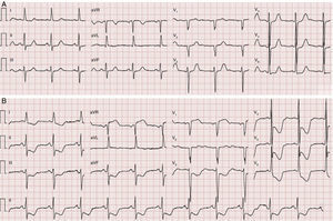 Electrocardiogram: (A) baseline; (B) during episode of chest pain, showing diffuse ST depression with a maximum of 7 mm in V4.