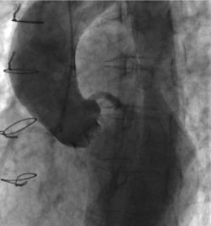 Aortography showing severe aortic regurgitation, for which the cause could not be identified.