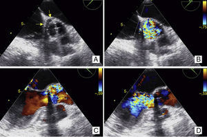 Transesophageal echocardiography: (A and B) short-axis view (40°), showing valve dehiscence in the region of the non-coronary cusp, affecting 25–30% of the perimeter of the prosthesis (yellow arrows); (C) (in systole) and (D) (in diastole), long-axis view (120°), showing turbulent regurgitant jet, wide at its source, filling the entire left ventricular outflow tract.