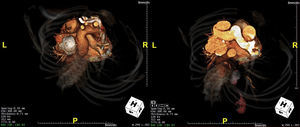 Computed tomography in 2006, before thoracic endovascular aortic repair.