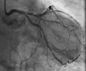 Initial angiogram. Distal left main bifurcation involving the ostia of the left descending and left circumflex arteries.