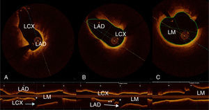 Pullbacks from (A) left anterior descending (LAD) and (B) left circumflex (LCx) arteries with 3D reconstruction; (C) distal left main (LM) before LAD and LCx ostia showing no significant stenosis (area 12 mm2). Carina with “eyebrow” shape, leading to plaque shift (see also Figure 3). *: carina; **: marginal branch.