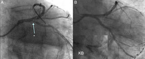 (A) Plaque shift (*) after implantation of a 3.0/38 mm stent in the ostial LAD; (B) final result after 3.5/18 mm stent implantation to the ostial LCx, with final kissing balloon (KB).