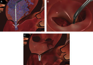 (A) Positioning of the MitraClip in the center of the regurgitant jet; (B) view of the MitraClip from the atrial side; (C) clip inserted and released. Adapted by permission from Abbott Vascular.