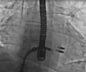 Angiographic image of the release of a second MitraClip.