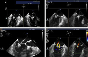 Implantation of a second MitraClip. If it is expected that a second clip will be required, the first should be placed in a mid position and the second more laterally. (A and B) Confirmation in different views of the position of the MitraClip; (C) the two mitral valve leaflets are grasped by the MitraClip; (D) after release, with residual regurgitation jets.