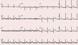 Electrocardiogram 15 h after admission to the emergency room.