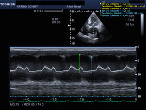 Example of M-mode apical systolic excursion measurement.