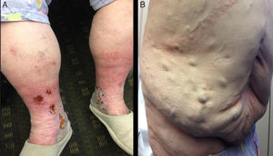 (A) Clinical presentation in a patient with IVC syndrome of venous stasis with bilateral telangiectasias, reticular and varicose veins, edema, skin pigmentation and chronic lipodermatosclerosis; (B) prominent dilated abdominal veins.