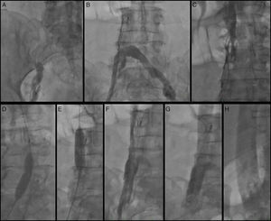 (A) Right femoral venogram; (B) left femoral venogram through Quick-Cross catheter demonstrating IVC interruption at the level of the IVC filter; (C) selective IVC venogram through Quick-Cross catheter above the IVC filter showing IVC stenosis; (D and E) balloon angioplasty of the IVC and right femoral vein through the IVC filter; (F) angiogram after percutaneous balloon angioplasty; (G and H) angiogram after stent placement.