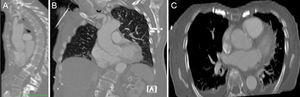 Computed tomography: (A) sagittal, (B) coronal and (C) axial views of the thorax.