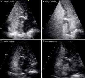 Transthoracic echocardiography: (A) upright position with right-to-left shunt after contrast injection in a peripheral vein; (B) supine position, with mild right-to-left shunt seen after contrast injection.