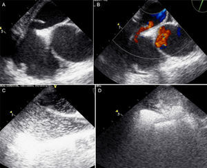 Tilt-table transesophageal echocardiography: (A) two-dimensional view at 45° unmasking a 4-mm patent foramen ovale (PFO); (B) color Doppler imaging showing a right-to-left shunt through the PFO; (C) bubble study at 0°; (D) bubble study at 45°.