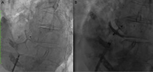 Cine-fluoroscopy of percutaneous patent foramen ovale (PFO) closure: (A) device delivery; (B) absence of contrast flow through the septum after PFO closure.