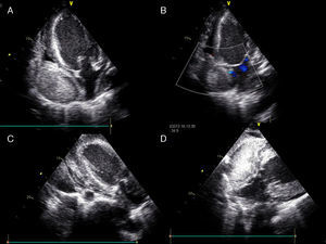 Transthoracic echocardiography showing a mass measuring 9cm×6cm and intermediate echogenicity causing almost complete collapse of the right atrium (A, B and D); mild (6mm) circumferential pericardial effusion (C).