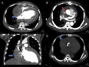 Contrast-enhanced computed tomography showing a hematoma 9.4cm×8.5cm×5.9cm compressing the right vena cava and right atrium (A, C and D); the collection was caused by an active bleeding point 2.4 cm above the aortic prosthesis (B) in the ascending aorta.