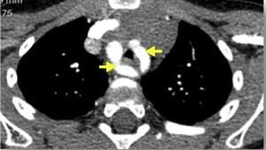 Thoracic computed tomography (angio-CT) angiography, axial view, showing two aortic arches (arrows) forming a double aortic arch, which surround the airway and reduce tracheal caliber. The right aortic arch is dominant.