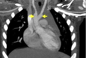 Thoracic angio-CT angiography, coronal maximum intensity projection reconstruction, showing two aortic arches (arrows) originating in the ascending aorta. The brachiocephalic trunk originates in the right aortic arch, while the left common carotid originates in the left aortic arch.