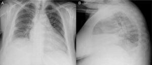 Chest radiograph.