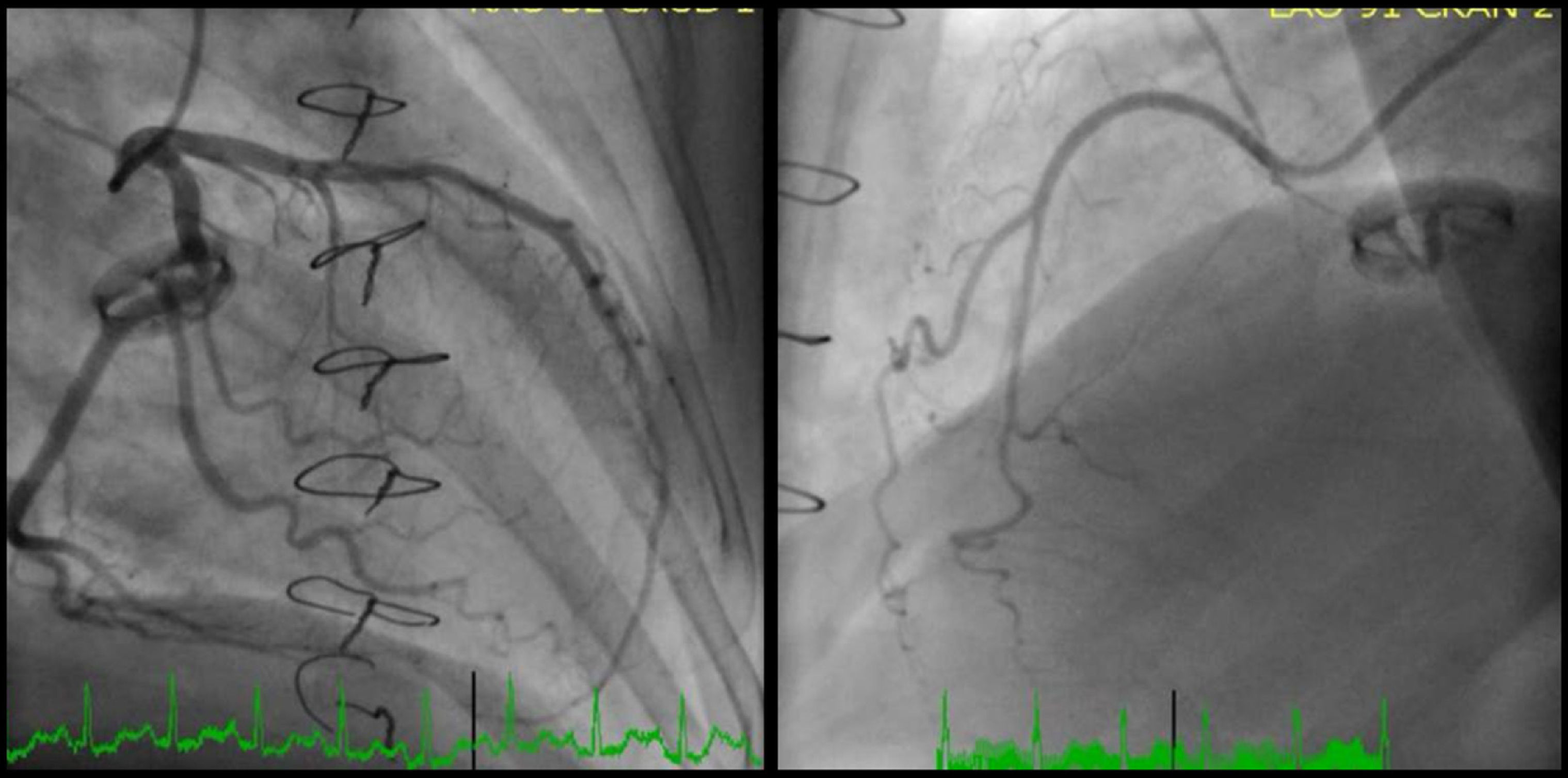 A 75-year-old woman with chest pain and transient severe left ...