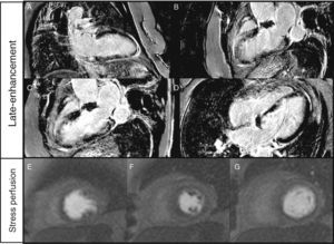 (A–G) Cardiac magnetic resonance imaging. Late-enhancement gadolinium evaluation showed transmural infarct scar in the inferoseptal wall and subendocardial infarct in the inferior and inferolateral walls (A–D). Ischemia (reversible perfusion defect) was documented in the mid-basal segments of the anterior and anterolateral walls (E–G).